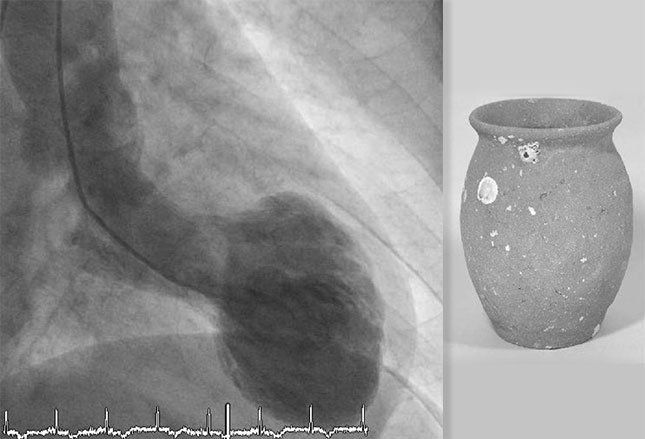 Sindrom patah hati atau Kardiomiopati Takotsubo (Richard C Ann/Medscape)