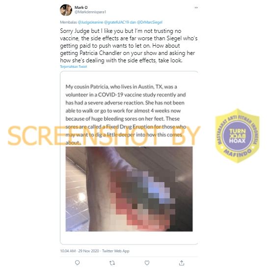CEK FAKTA Efek samping vaksin Covid-19 bikin melepuh. (Dok. Tangkapan layar Turnbackhoax.id)