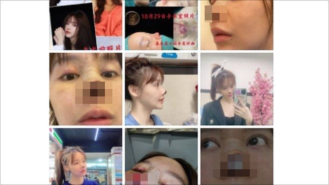 Bukannya Makin Cantik, Hidung Artis Tiongkok Gao Liu Membusuk usai Oplas. (Sina Weibo/Gao Liu)