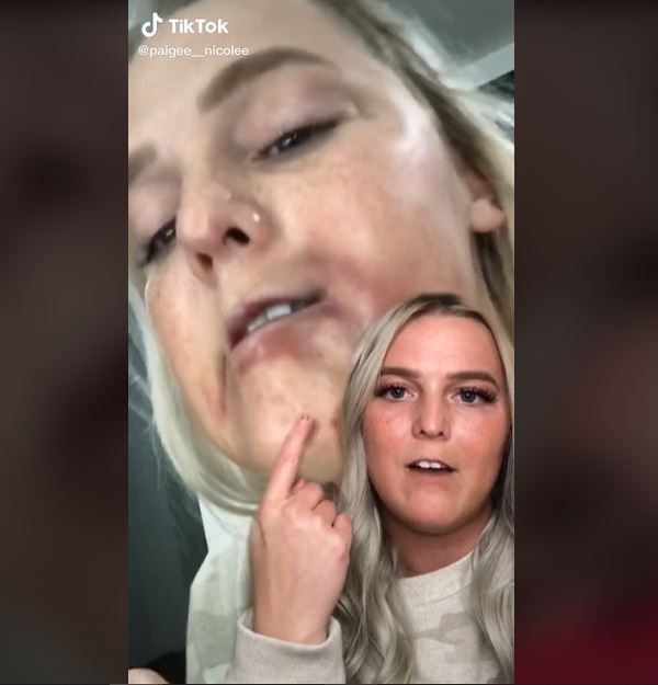 Suntik Filler Bibir, Wajah Wanita Ini Malah Dipenuhi Memar (tiktok.com/@paigee__nicolee)