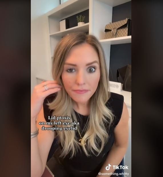 Salah Suntik Botox, Mata Wanita Ini Turun Sebelah (tiktok.com/@something.whitty)