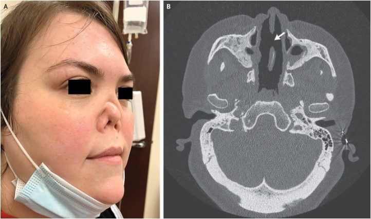 Kasus wanita menderita Granulomatosis dengan poliangiitis (NEJM)