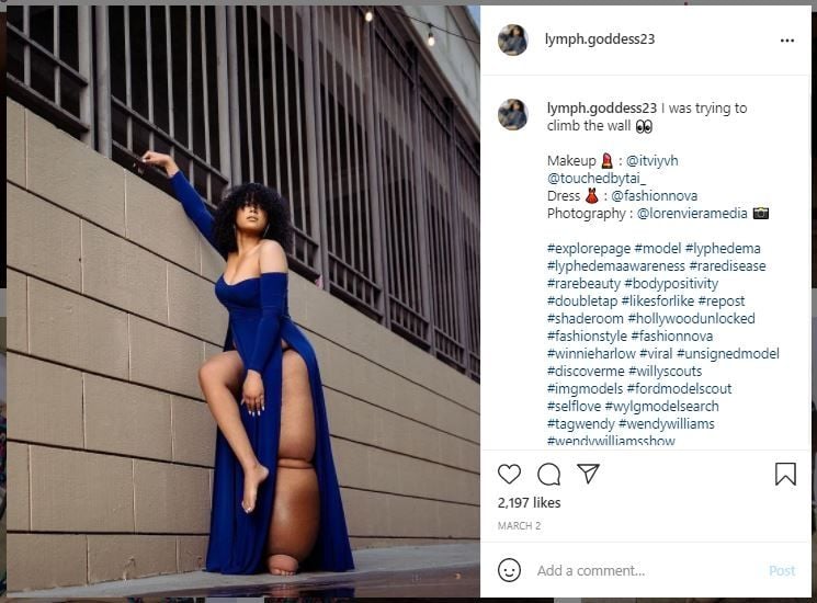 Model Idap Kondisi Kaki Bengkak Sebelah, Sering Diejek Suruh Amputasi (instagram.com/lymph.goddess23)