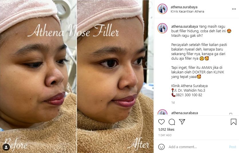 Potret penampilan Kekeyi usai filler hidung. (Instagram/athena.surabaya)