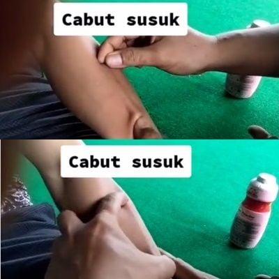 Viral Video Proses Cabut Susuk Bikin Ngilu. (Instagram/@makassar_iinfo)