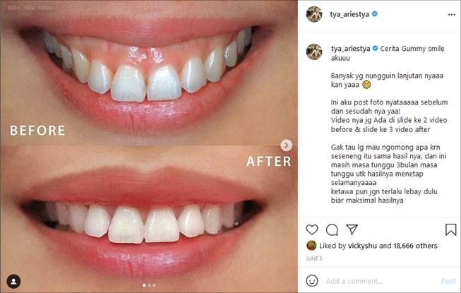 Tya Ariestya perawatan gigi hingga potong gusi. (Instagram/@tya_ariestya)
