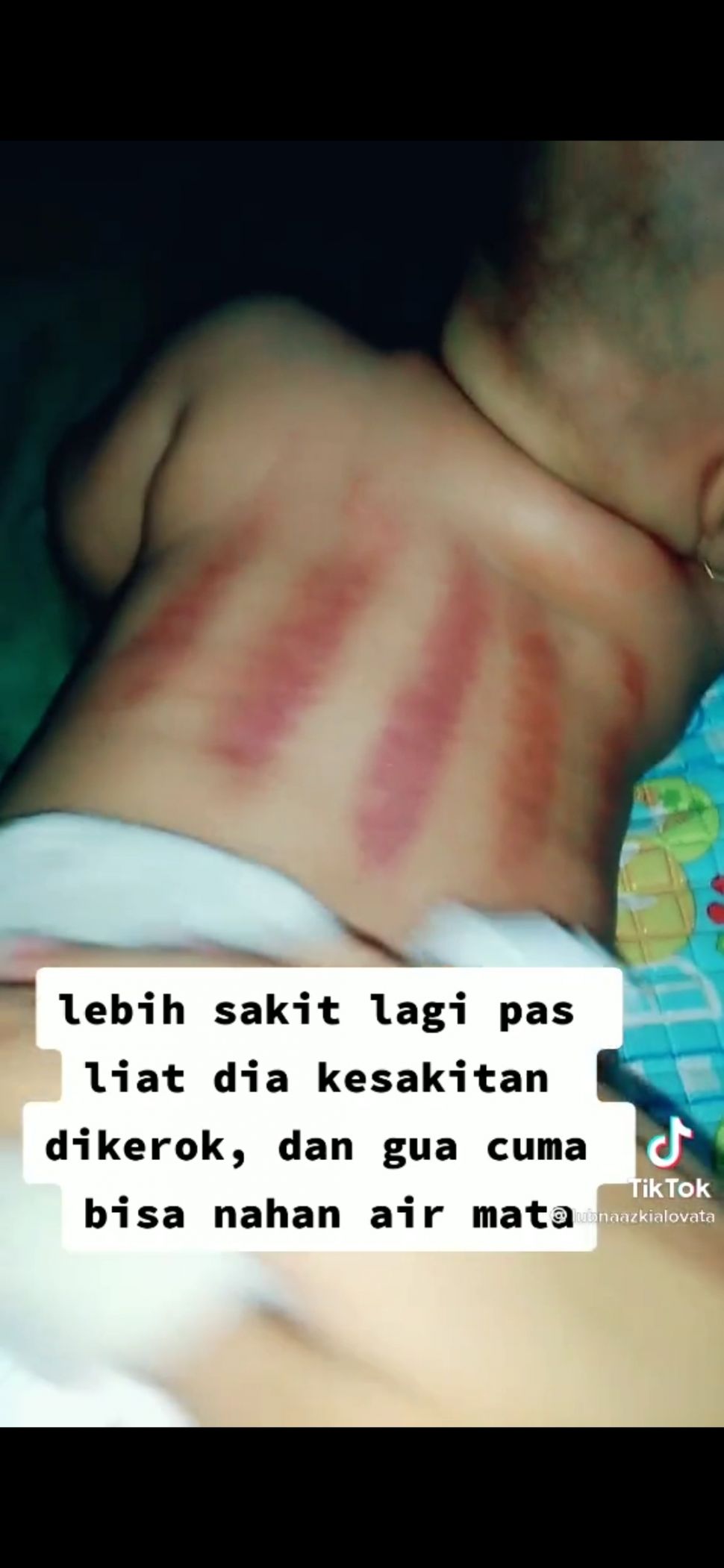 Takut Dibilang Corona, Ibu Ini Pilih Kerok Bayinya Sampai Kulitnya Memerah. (Dok: TikTok/