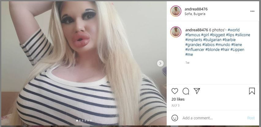 Wanita Ingin Punya Bibir Terbesar, Tak Peduli Dibenci Keluarga (instagram.com/andrea88476)