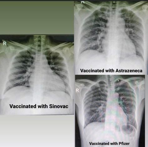 Viral foto paru-paru pasien COVID-19 setelah disuntik vaksin Sinovac, Astrazeneca, dan Pfizer.