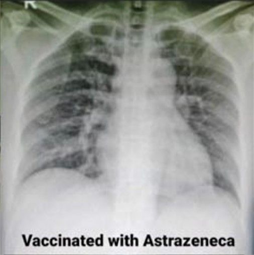 Viral foto paru-paru pasien COVID-19 setelah disuntik vaksin Sinovac, Astrazeneca, dan Pfizer.