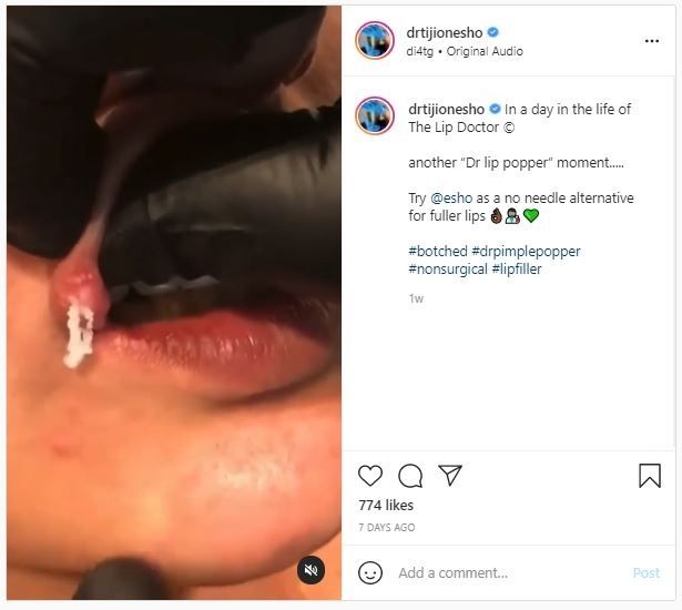 Viral Dokter Keluarkan Filler Bibir yang Gagal (instagram.com/drtijionesho)