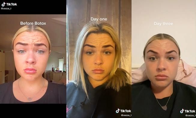 Viral wanita lakukan suntik botox malah dibilang wajahnya menua. (TikTok/@cezza_ta)