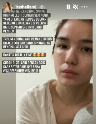Momen Sheila Marcia hapus tato. (Instagram/itssheilamj)
