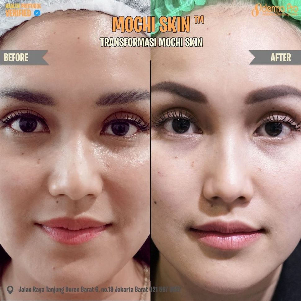 Potret Ayu Ting Ting sebelum dan sesudah perawatan. (Instagram/klinikdermaprojakarta)