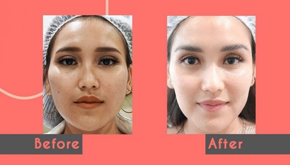 Potret Ayu Ting Ting sebelum dan sesudah perawatan. (Instagram/klinikdermaprojakarta)