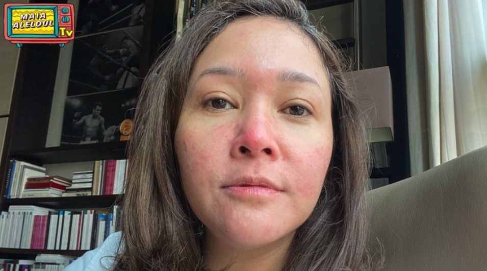 Maia Estianty Mengidap Penyakit Kulit Bawaan, Rosacea. (YouTube Maia AL EL DUL TV)