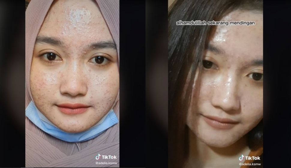 Viral Curhat Wanita Berubah Jerawatan setelah Coba Pakai Masker (tiktok.com/@adelia.ksmw)