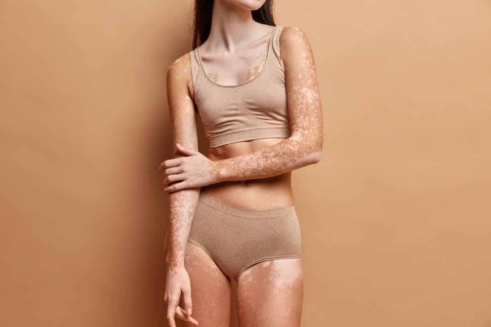 Bedanya Vitiligo dengan Albino (Elements Envato)