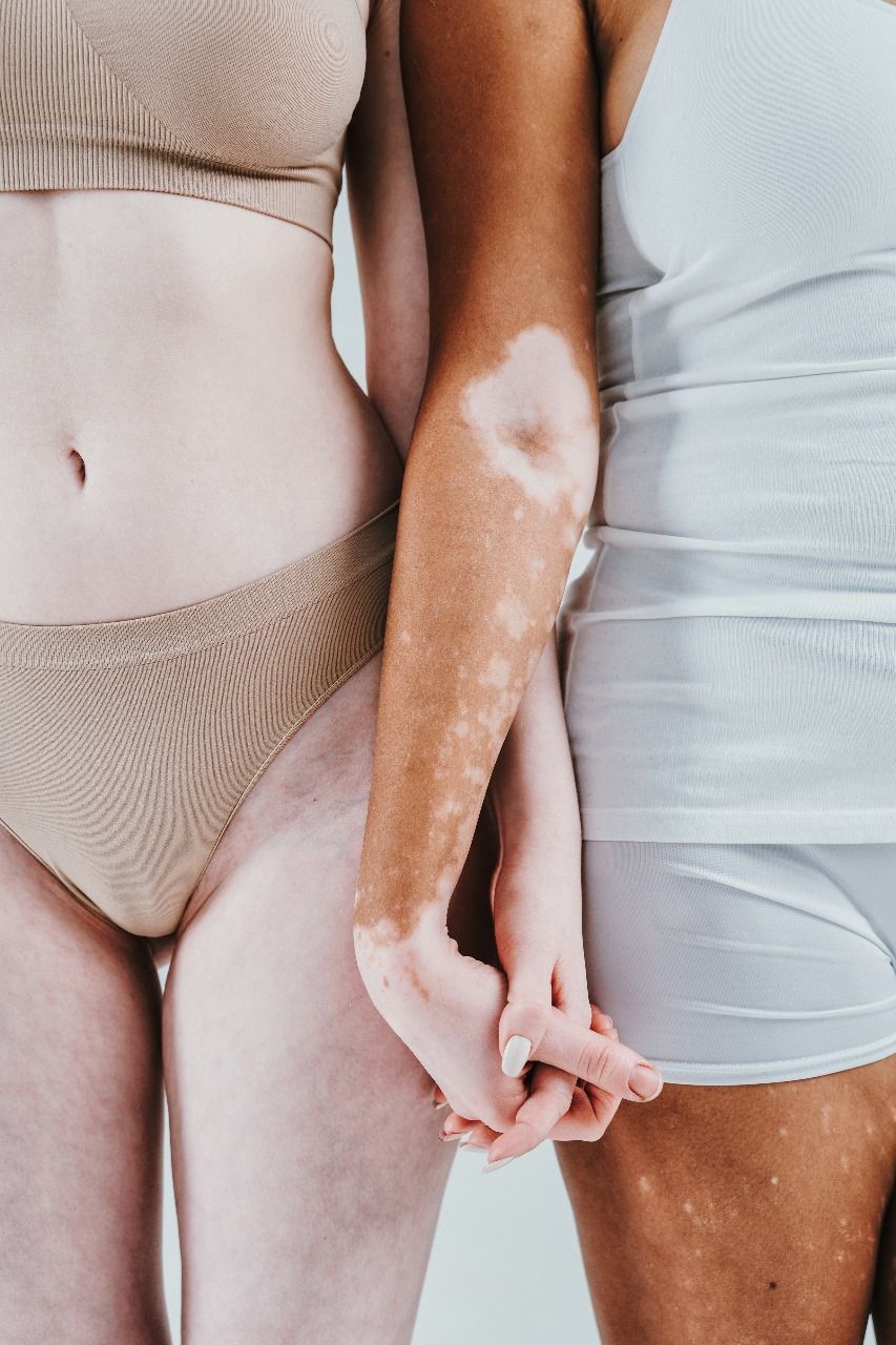 Bedanya Vitiligo dengan Albino (Elements Envato)