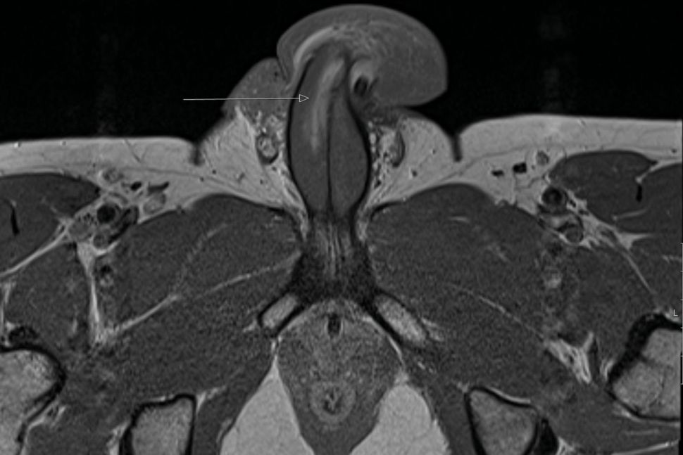 Penis patah. (Dok: BMJ Case Reports)