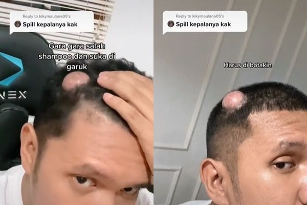 Viral Pria Cerita Kepala Dioperasi Gegara Suka Garuk-garuk. (TikTok)