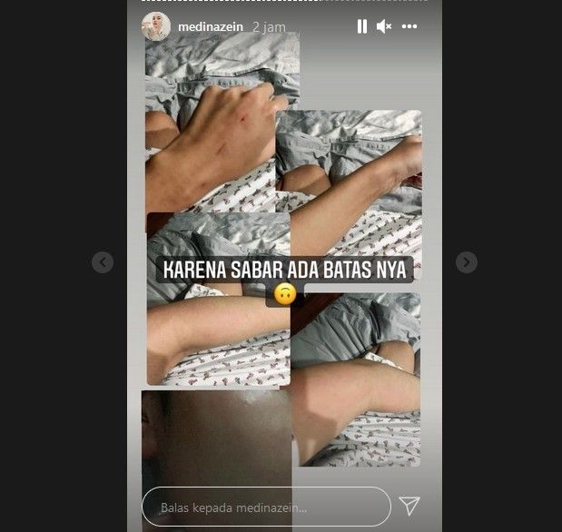 Medina Zein mengungkap luka di tangannya akibat mendapat KDRT dari sang suami, Lukman Azhari. [Instagram]