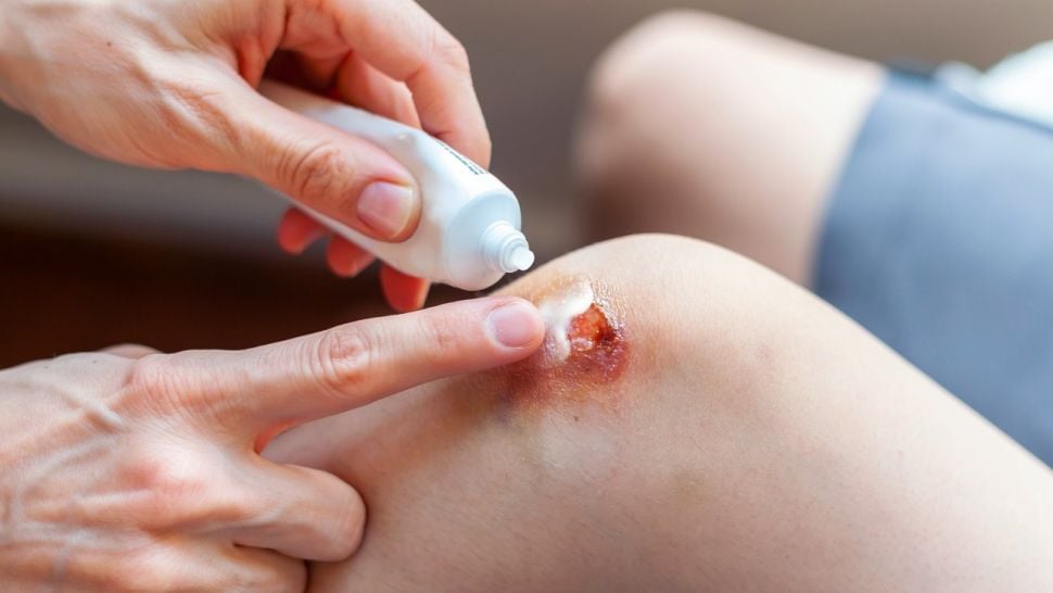 Mengenal Moist Wound Healing, Metode Penanganan Luka yang DIklaim Efektif. (Dok: Istimewa)