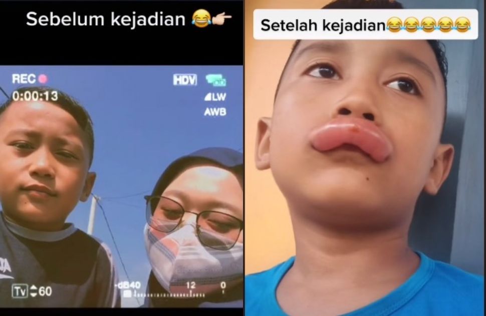 Bocah bibir kembung (tiktok.com/@mvi___/video)