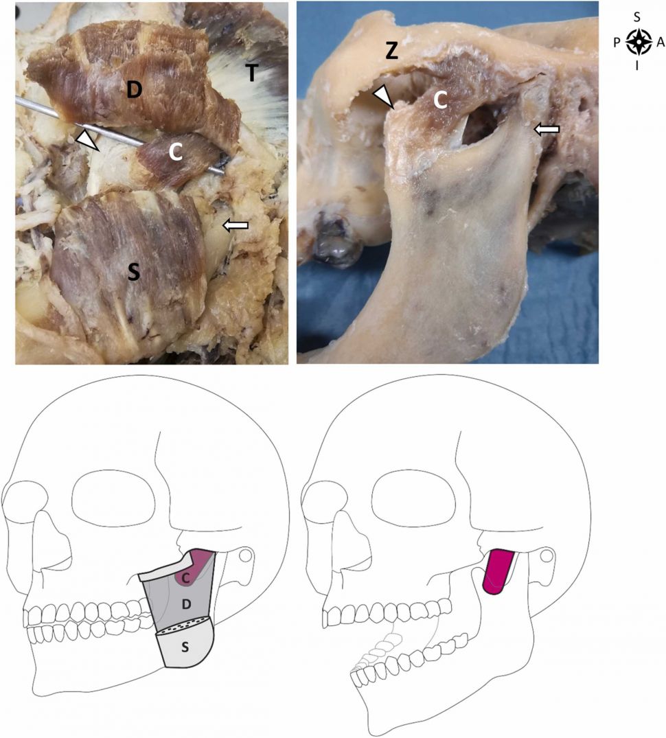 Musculus masseter pars coronidea (Annals of Anatomy Journal)