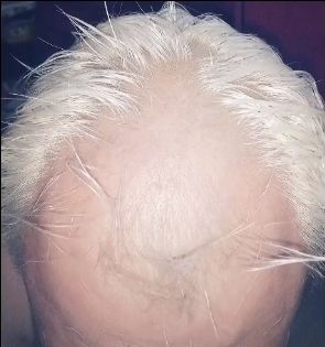 Penampakan rambut sang pria yang rusak hingga botak akibat asal bleaching. (TikTok/si_dado2)