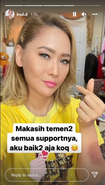 Inul Daratista ungkap kondisi setelah posting gambar tangan memar [Instagram/@inul_d]