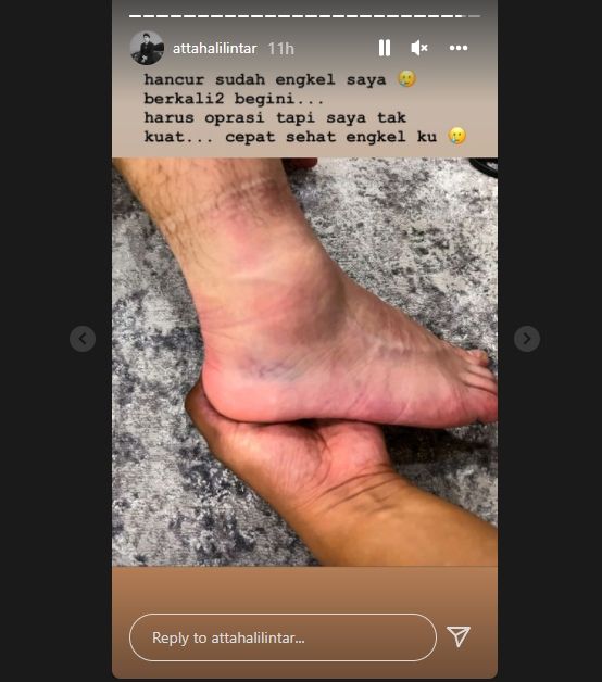 Atta Halilintar cedera di bagian kaki [Instagram/@attahalilintar]