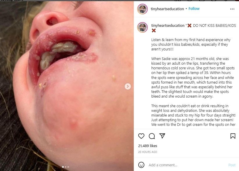 Sandie yang terinfeksi herpes simplex (Instagram)