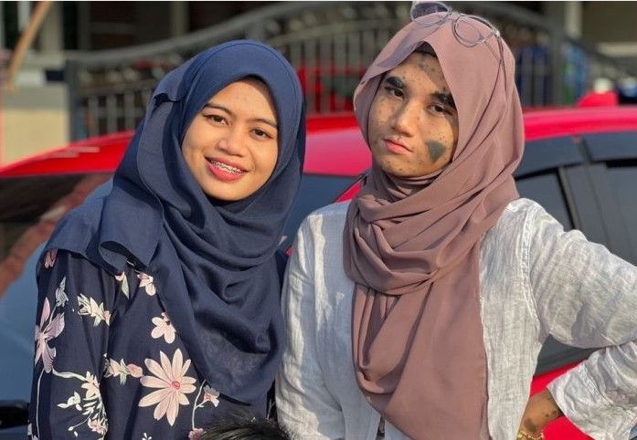 Viral Gadis Malaysia Dipenuhi Tanda Lahir di Wajah, Sering Diejek Tapi Malah Jadi 'Seleb' TikTok. (Dok: Istimewa)