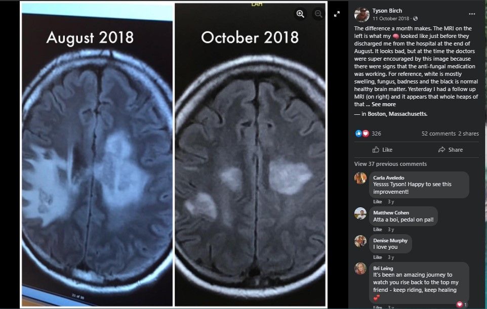 Hasil MRI jamur hitam di otak Tyson (Facebook)