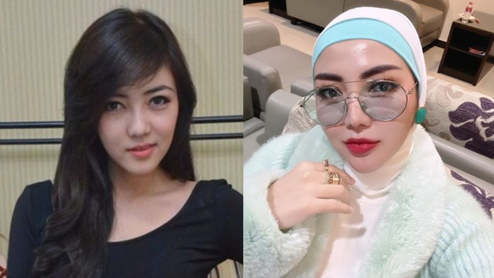 Potret Artis Setelah Operasi Plastik (Instagram)