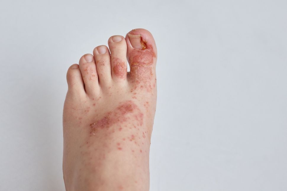 Mengenal Dermatitis Atopik Dan Perawatannya Penyakit Kulit Yang Tak