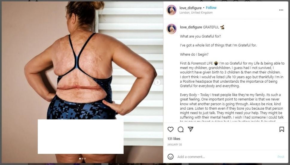 Punya Luka Bakar Besar di Punggung, Ibu Ini Pede Jadi Model Bikini (instagram.com/love_disfigure)