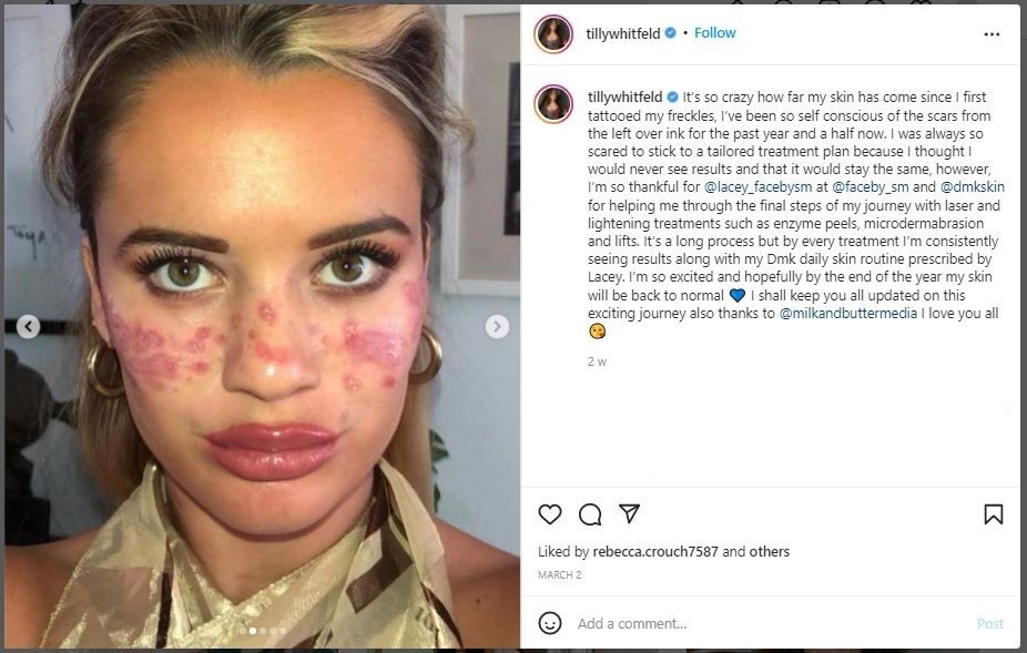 Nyaris Buta karena Tato Freckles, Influencer Ini Nggak Kapok Mau Menato Bibir (instagram.com/tillywhitfeld)