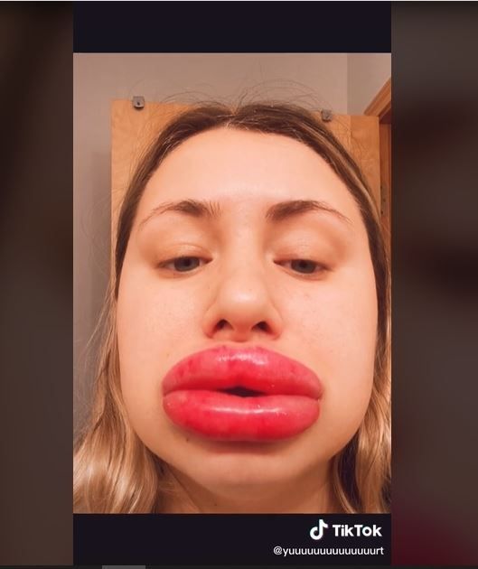 Viral Bibir Wanita Ini Bengkak 8 Kali Lipat karena Filler (tiktok.com/yuuuuuuuuuuuuuurt)
