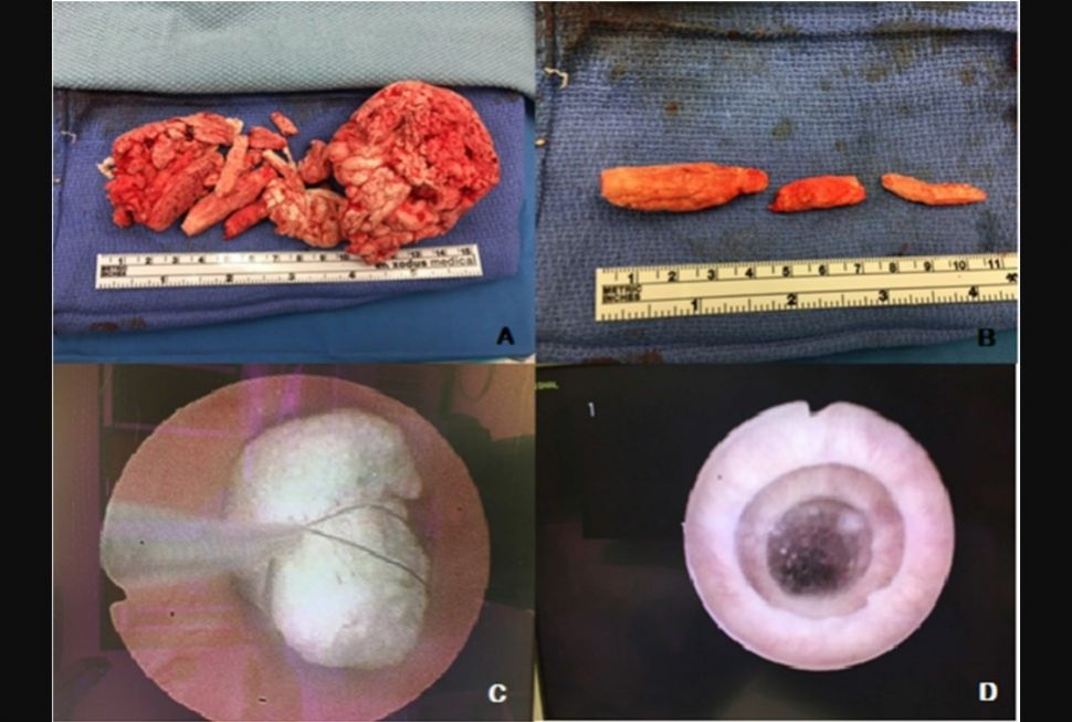 Busa yang mengeras dan dikeluarkan dari uretra (Sciencedirect)