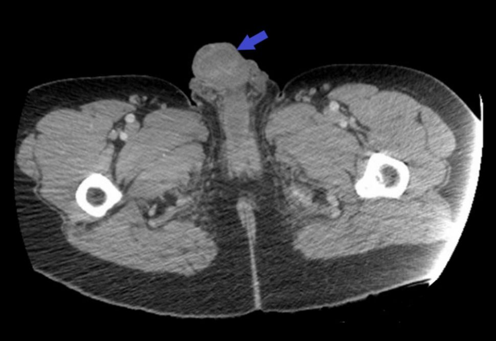 MRI dari pria yang menyuntikkan kokain ke penisnya (American Journal of Case Reports)