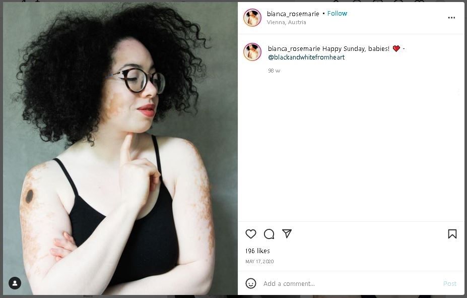 Curhat Model Mengidap Vitiligo, Sempat Diejek Mirip Sapi (instagram.com/bianca_rosemarie)