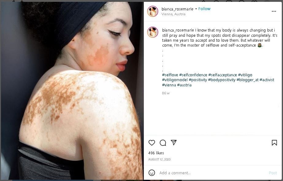 Curhat Model Mengidap Vitiligo, Sempat Diejek Mirip Sapi (instagram.com/bianca_rosemarie)