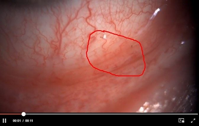 Larva di dalam mata tukang kebun (NEJM)