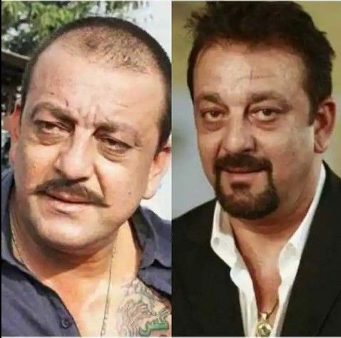 Sanjay Dutt melakukan transplantasi rambut. [Bollywoodlife]