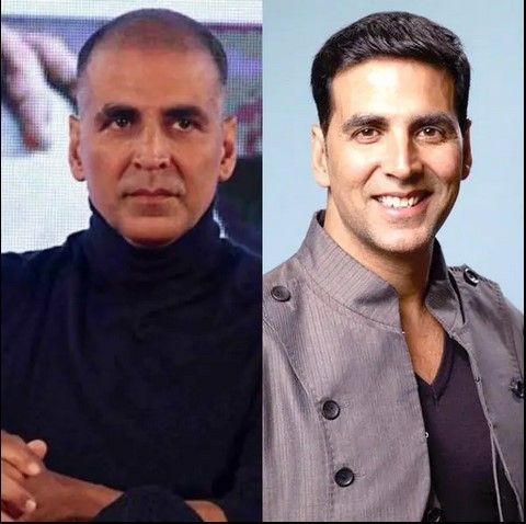 Akshay Kumar lakukan transplantasi rambut. [Bollywoodlife]