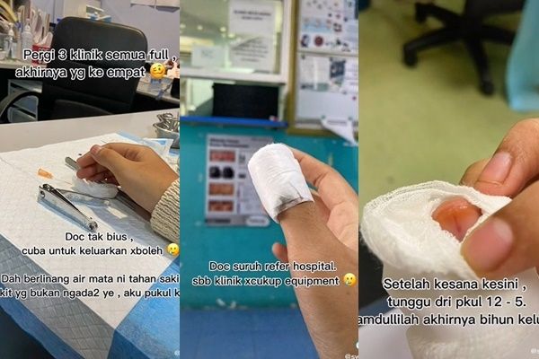 Viral Wanita Berakhir di Rumah Sakit Gegara Bihun Kering Nyangkut di Kuku (TikTok)