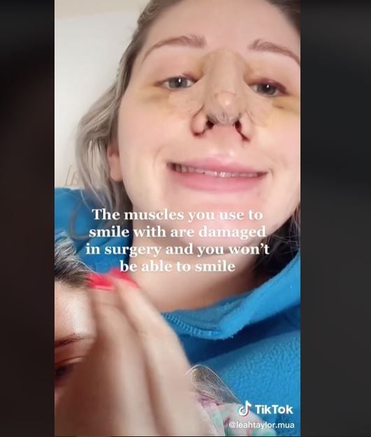 Viral Wanita Bagikan Realita Operasi Plastik Hidung (tiktok.com/leahtaylor.mua)