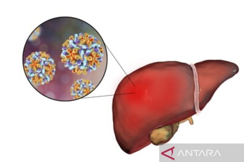 Hepatitis Akut [Antara]